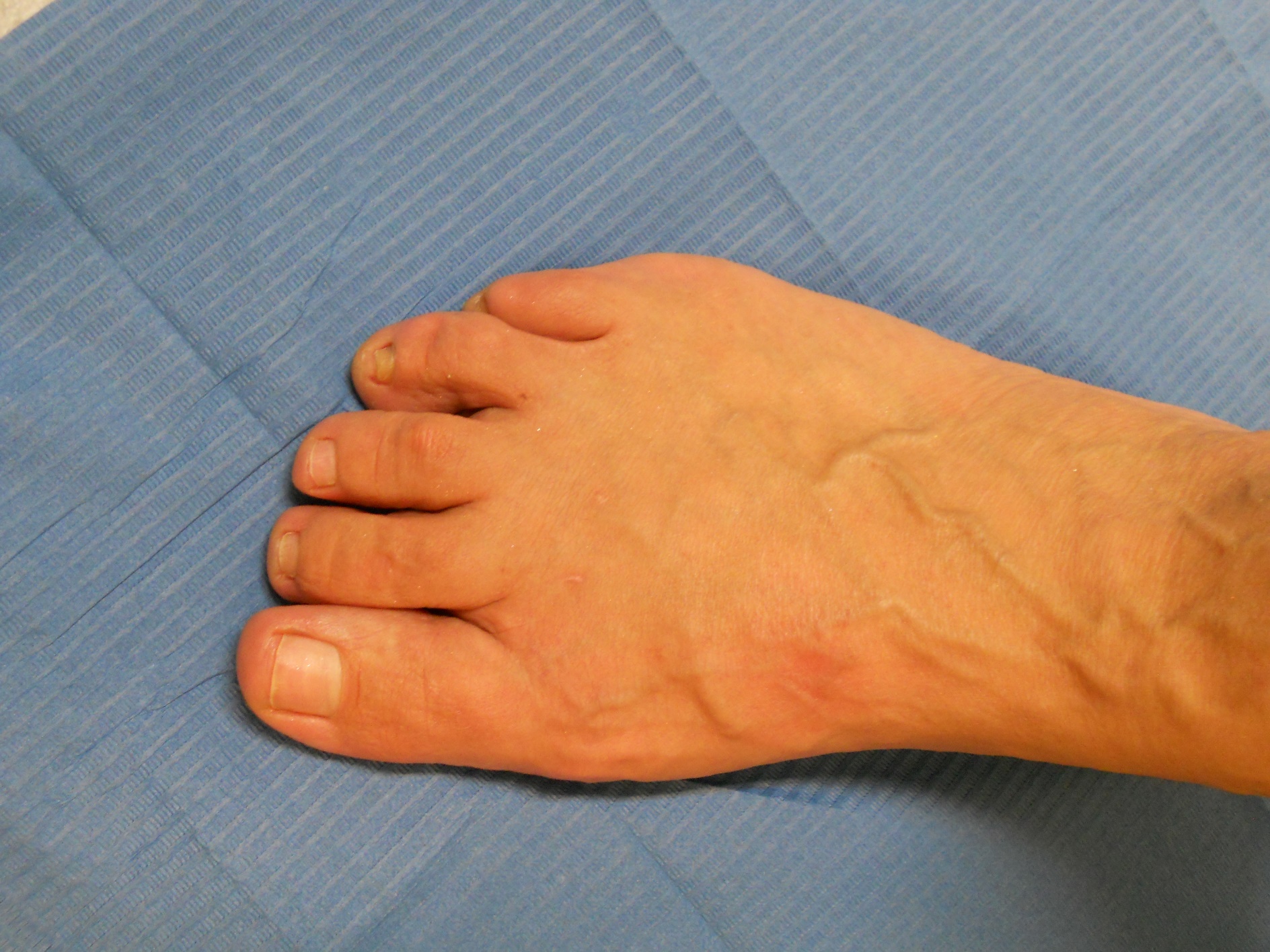 Hallux valgus: después