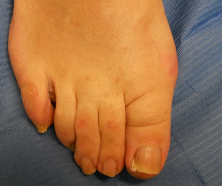 Hallux valgus (juanete) y dedos en garra: después